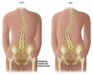 Fonksiyonel Skolyoz Egzersizleri