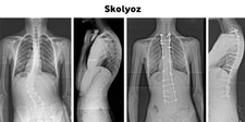 Skolyoz Çeşitleri Nelerdir?