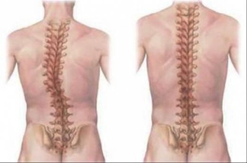 Skolyoz Eğriliği Egzersizleri Nelerdir?