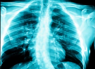 Skolyoz Tetkiki Nedir?